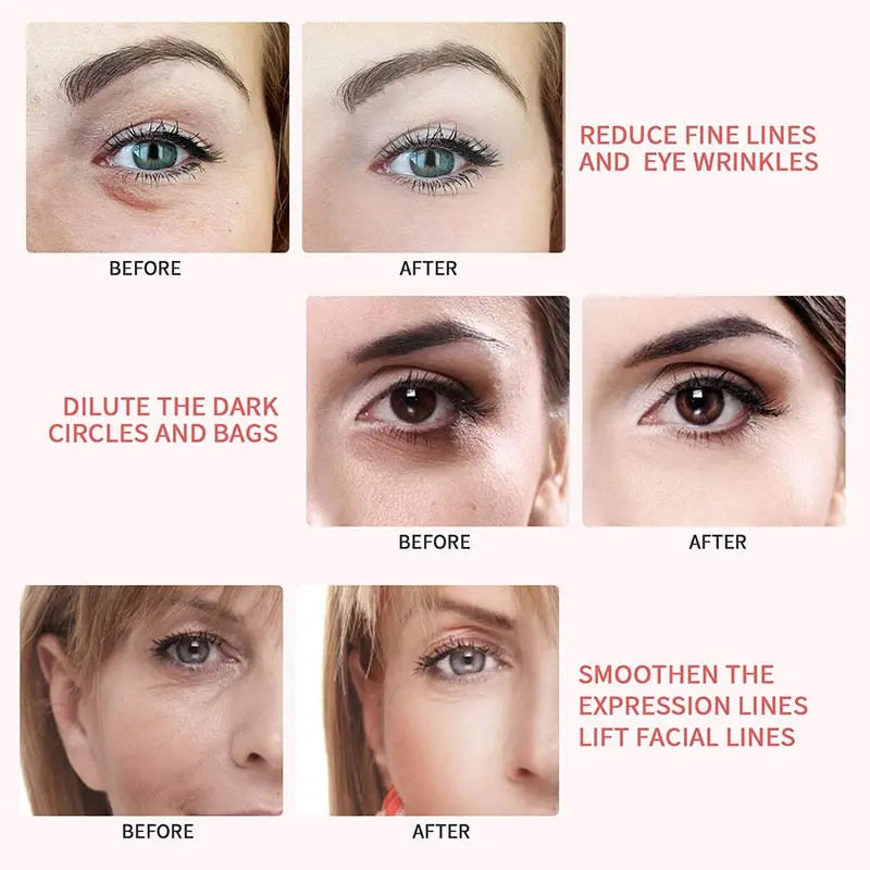 5-in-1 EMS RF Facial Lift eprolo