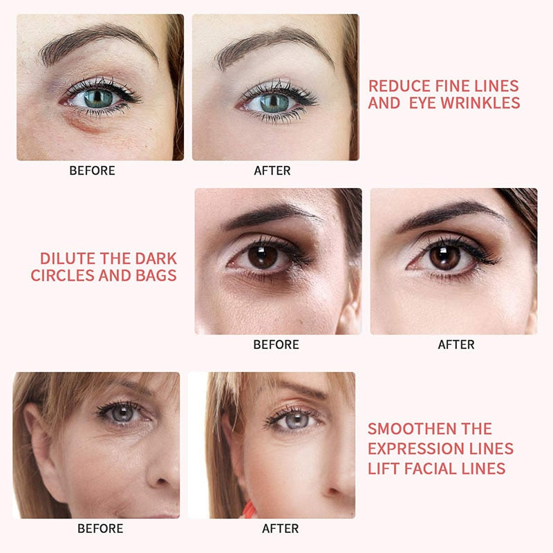 5-in-1 EMS RF Facial Lift